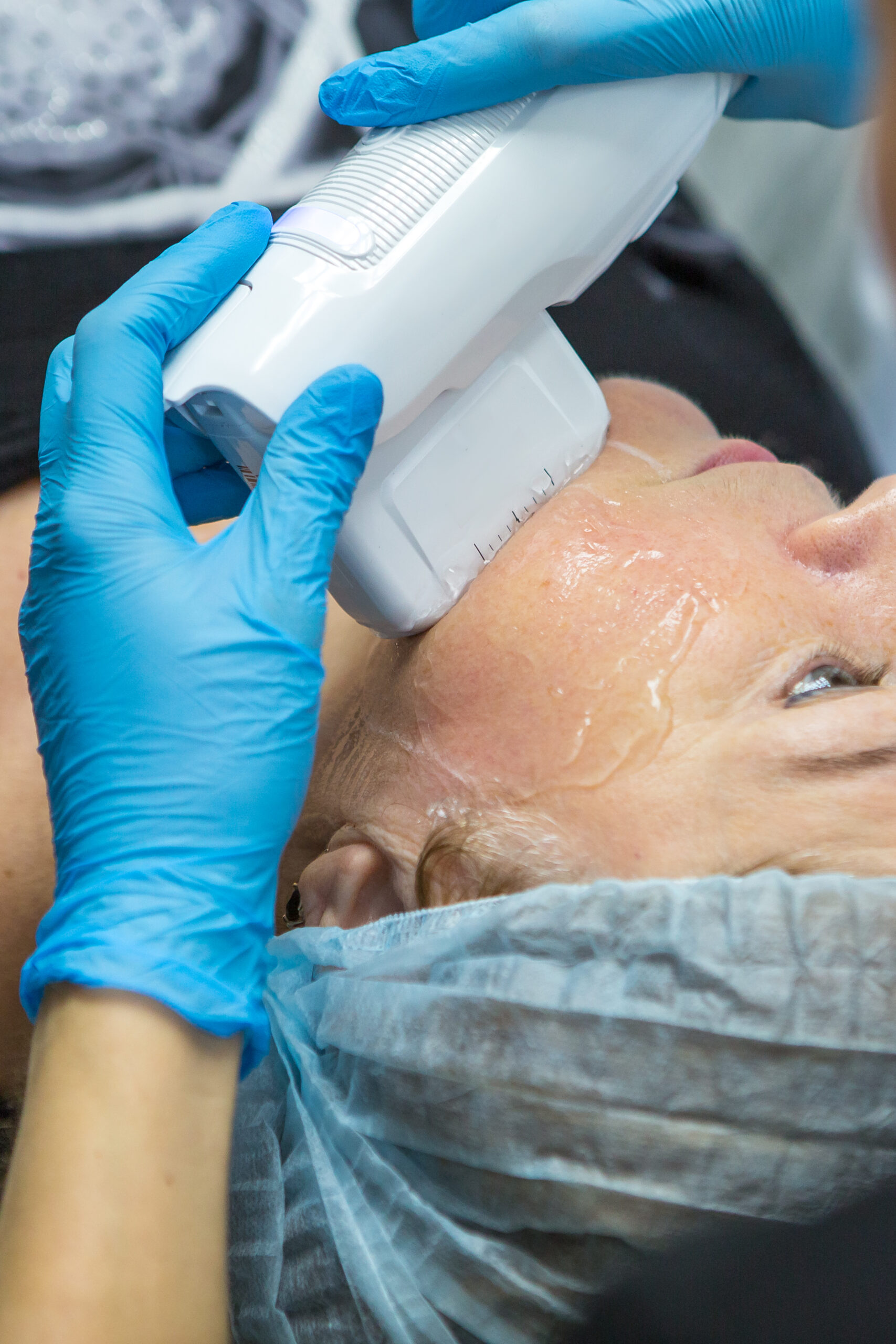 Technique HIFU du visage chez Epilzen à Liège
